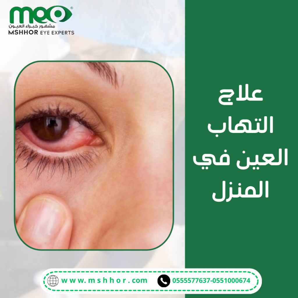 طرق علاج التهاب العين في المنزل