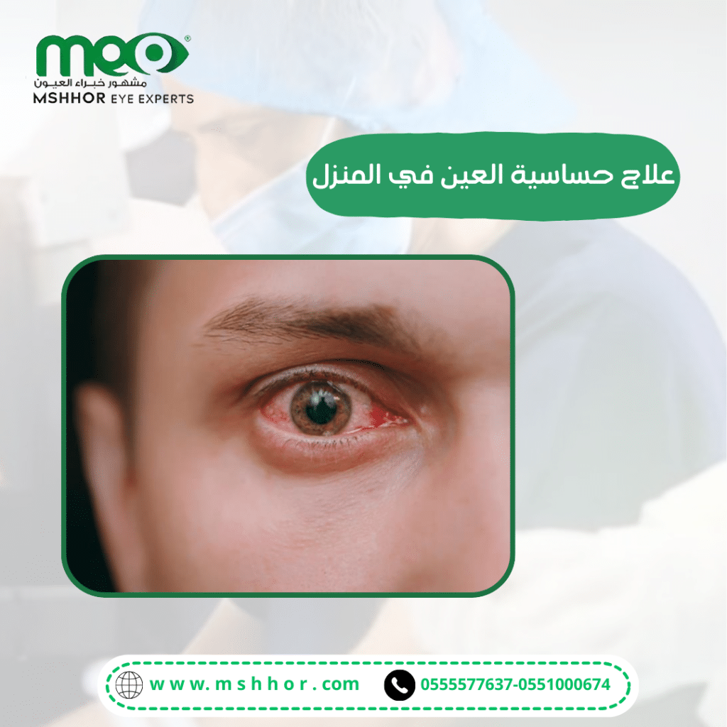 تعريف علاج حساسية العين من المنزل