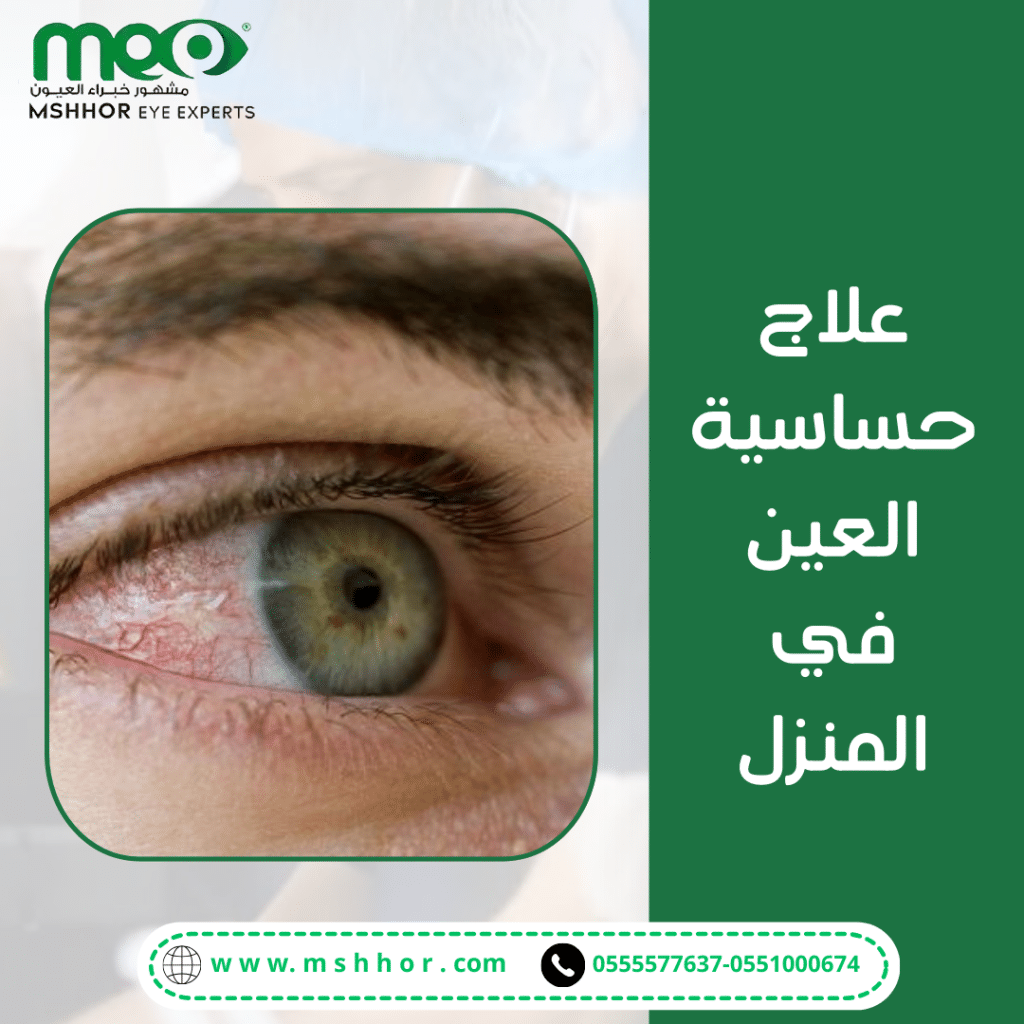 علاج حساسية العين في المنزل يعتمد علي تجنب مسببات الحساسية في المنزل