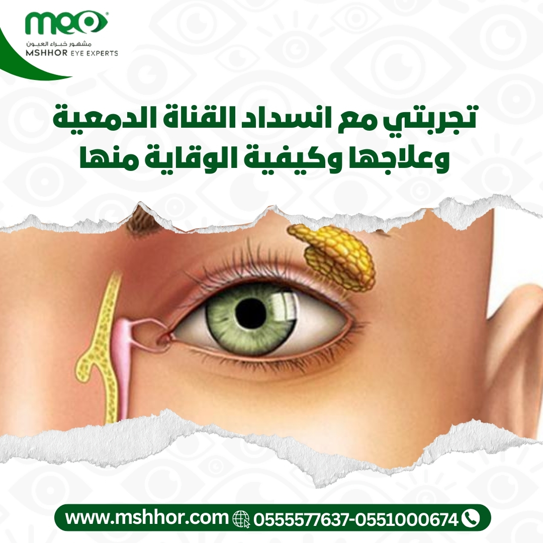 تجربتي مع انسداد القناة الدمعية