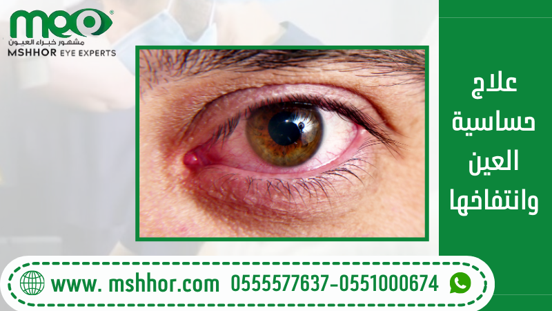 علاج حساسية العين وانتفاخها 