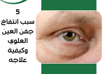 5 سبب انتفاخ جفن العين العلوي وكيفية علاجه