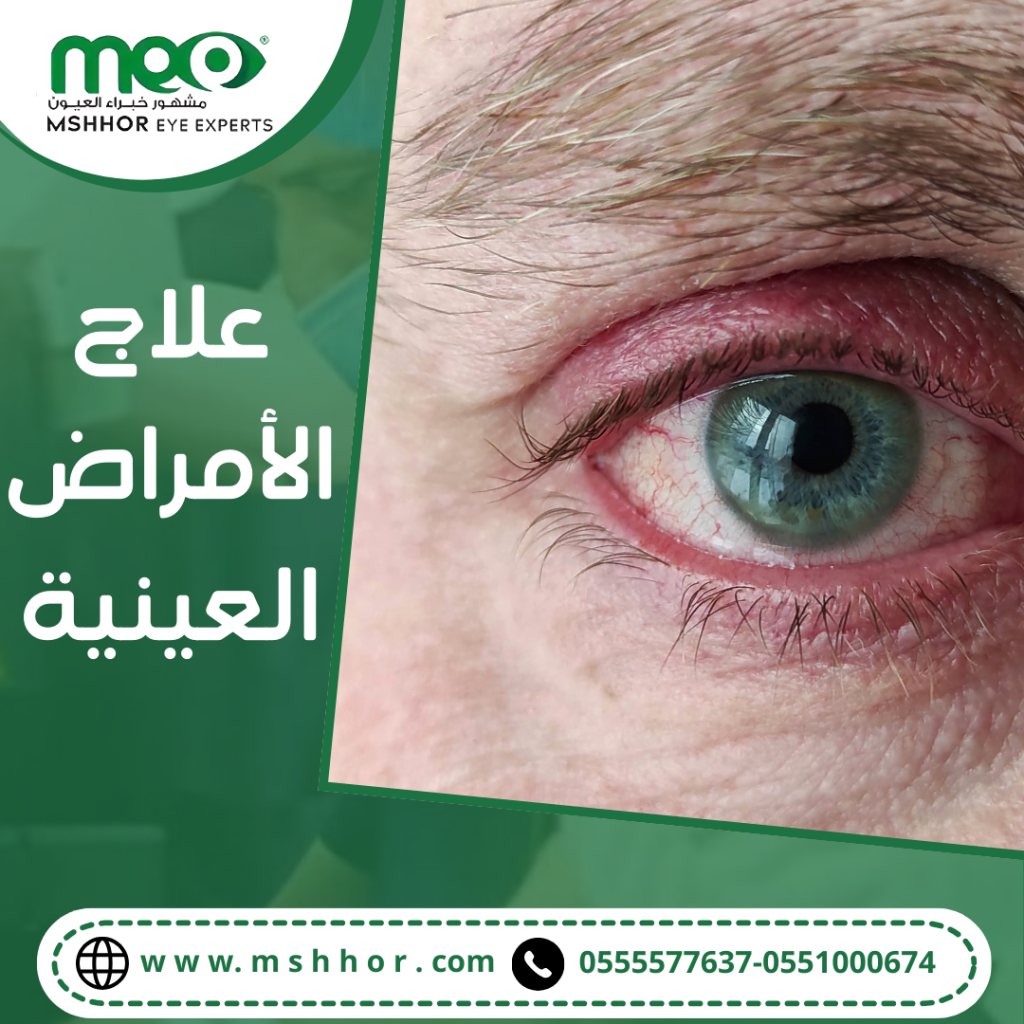 علاج الأمراض العينية 
