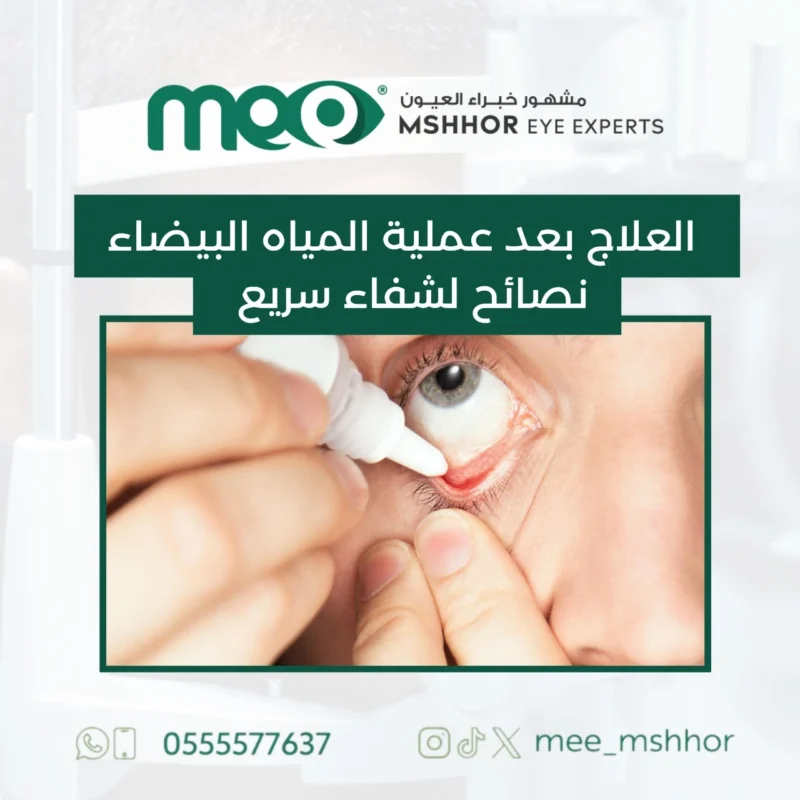 العلاج بعد عملية المياه البيضاء