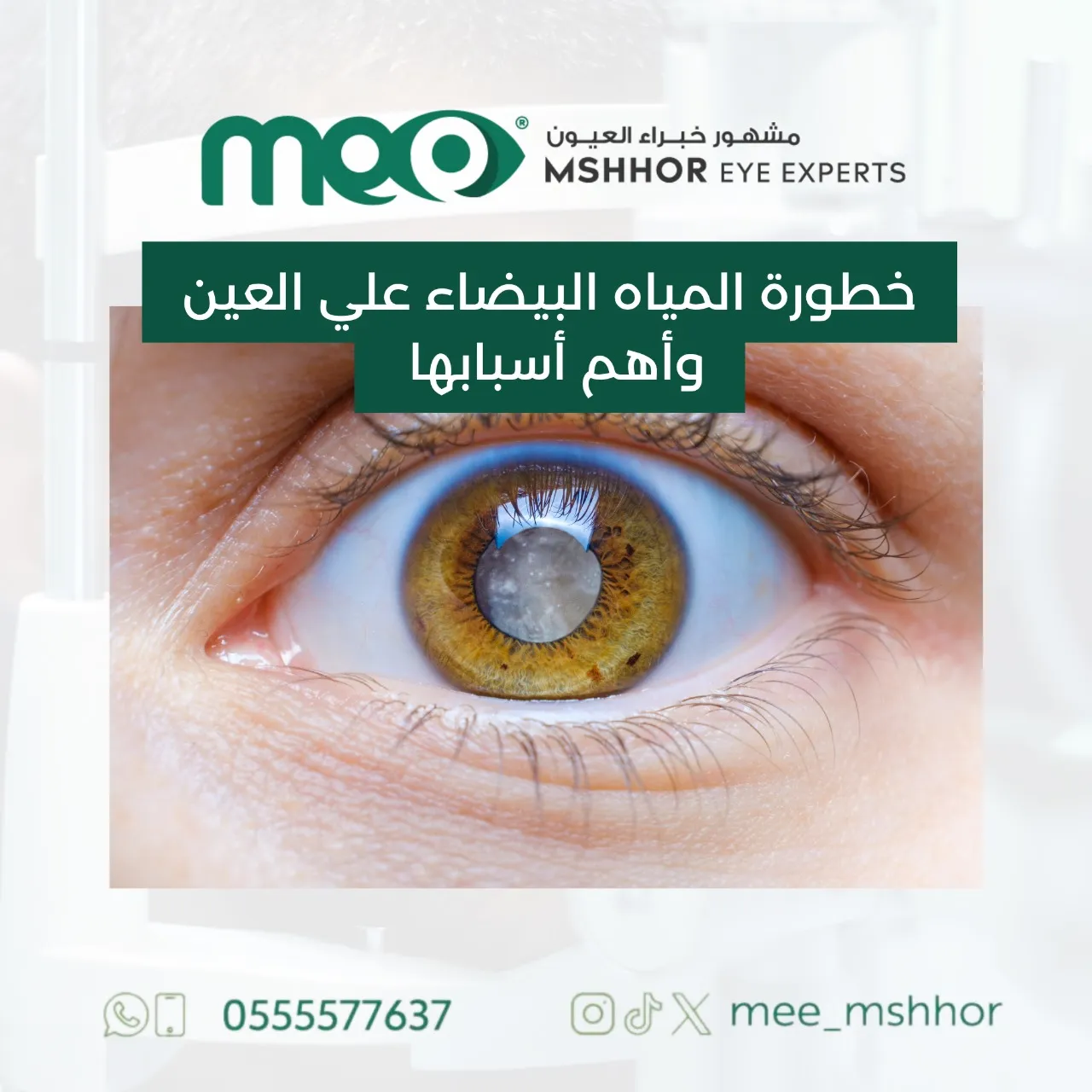 خطورة المياه البيضاء على العين