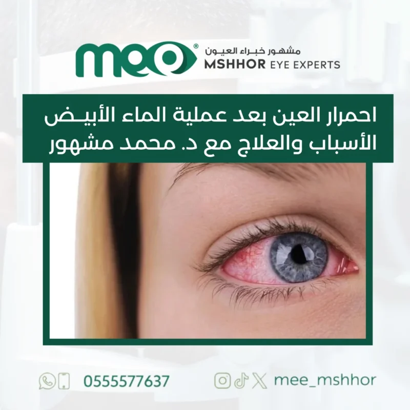 احمرار العين بعد عملية الماء الابيض