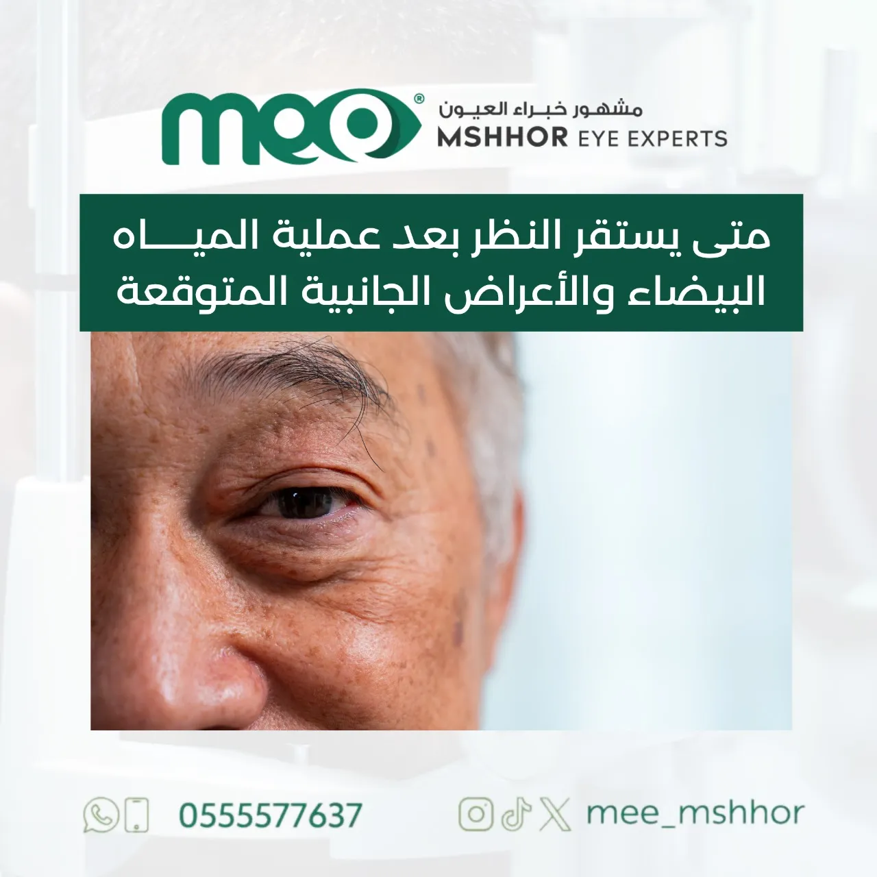 متى يستقر النظر بعد عملية المياه البيضاء