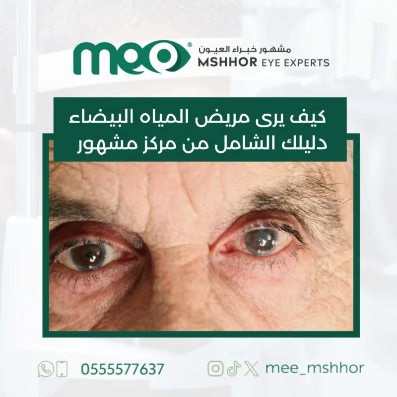 كيف يرى مريض المياه البيضاء