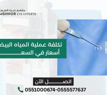 تكلفة عملية المياه البيضاء في العين