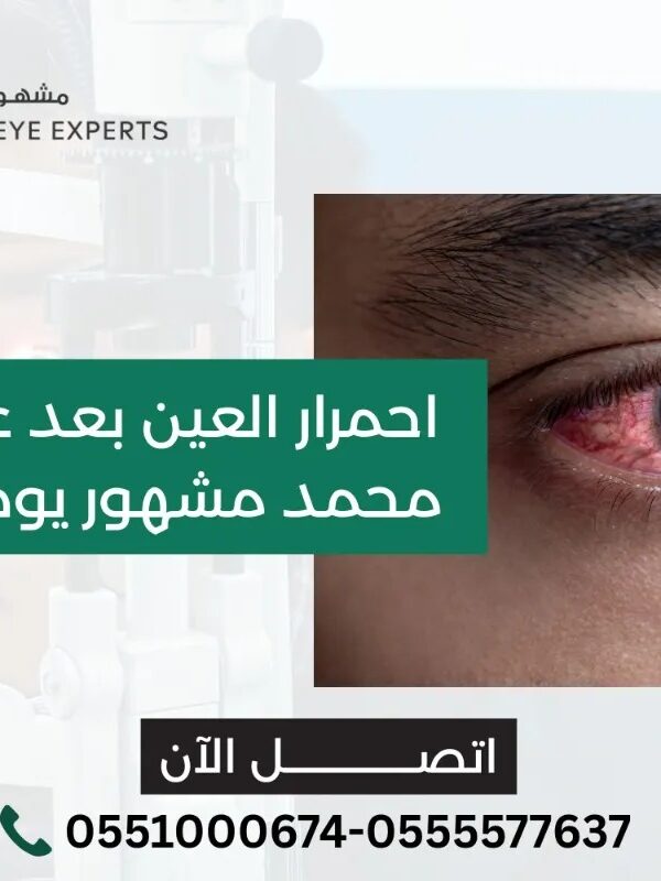 احمرار العين بعد عملية الليزك